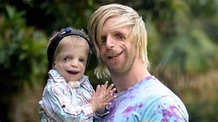 سندروم تریچر کالینز (Treacher Collins syndrome)چیست؟ همه چیز درمورد آن