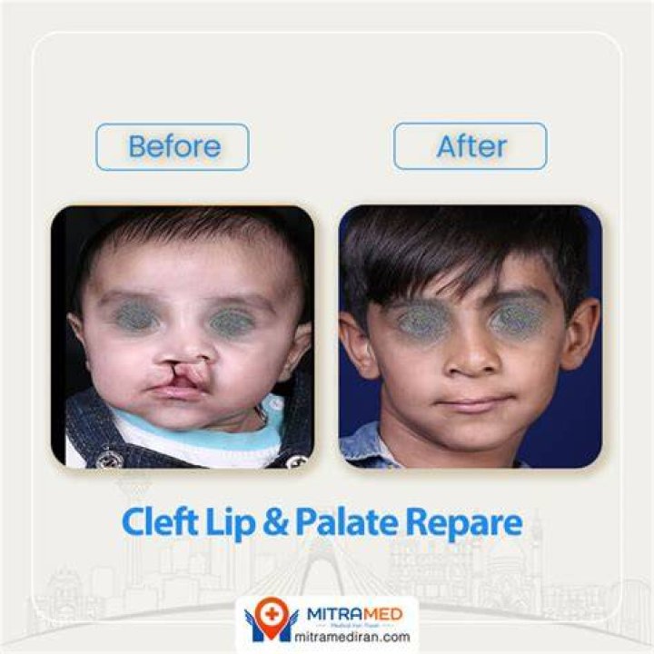 Cleft Lip and Palate Repair Johns Hopkins Facial Plastic and