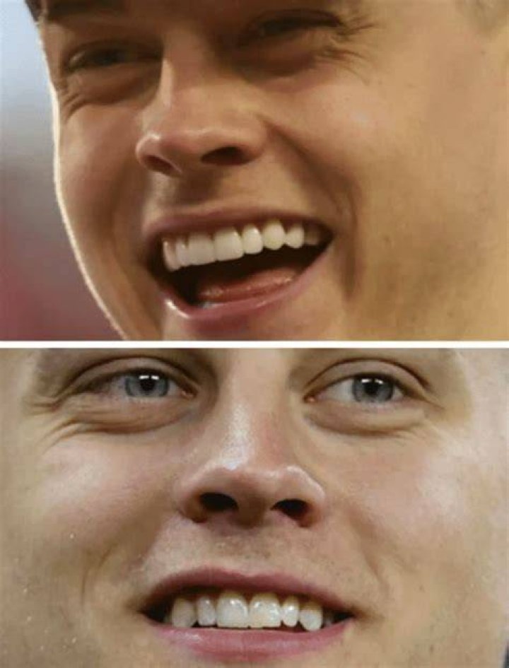 Joe Burrow Veneers vorher und nachher Neue Zähne bekommen, Joe Burrow