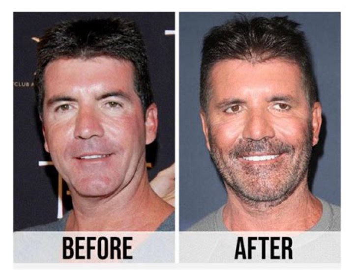 Simon Cowell Before And After Pictures What Happened With Simon Cowell?