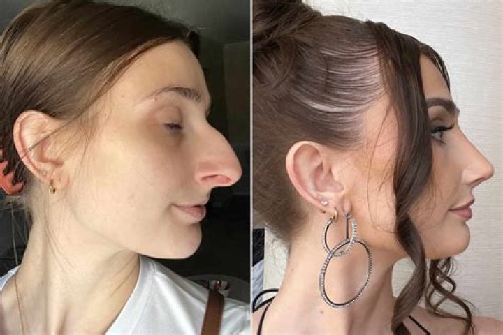 Sssniperwolf&rsquo;s Nose Job Before And After Photos Justinboey
