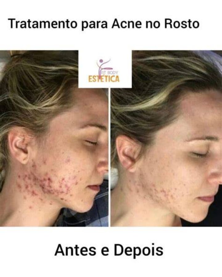 Tratamento contra acne e mutilação genital A suposta castração química