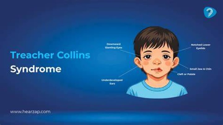 Treacher Collins Syndrome Causes, Symptoms, and Treatment