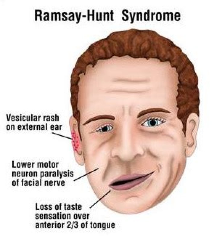 Understanding Ramsay Hunt Syndrome: Causes, Symptoms And Treatment