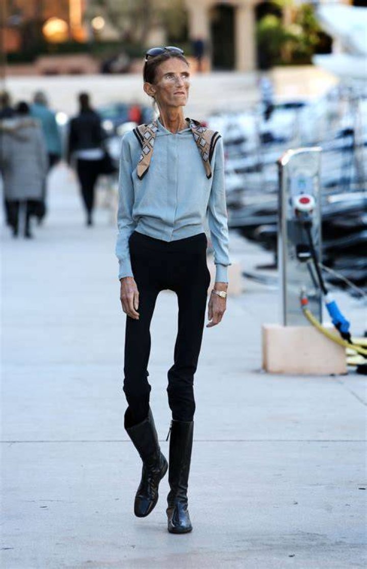 Valeria Levitin,The World’s Thinnest Woman Campaigns Against Anorexia
