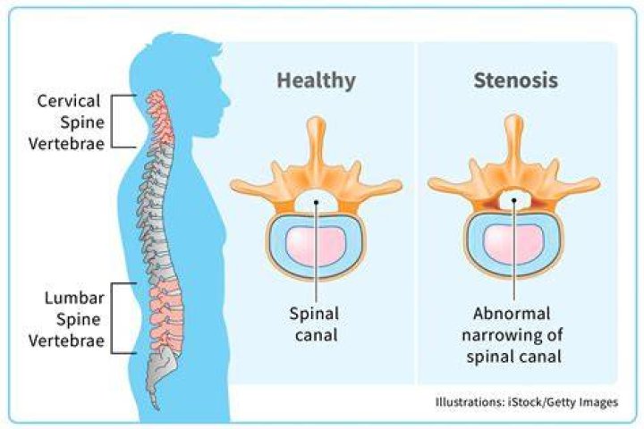 What Is Spinal Stenosis And How Can It Be Treated? Homewood
