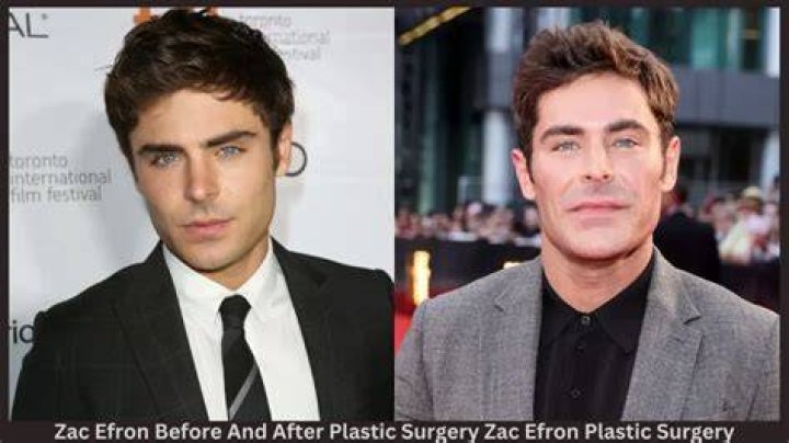 Zac Efron Plastic Surgery Video Before & After Photos In 2022 Has He